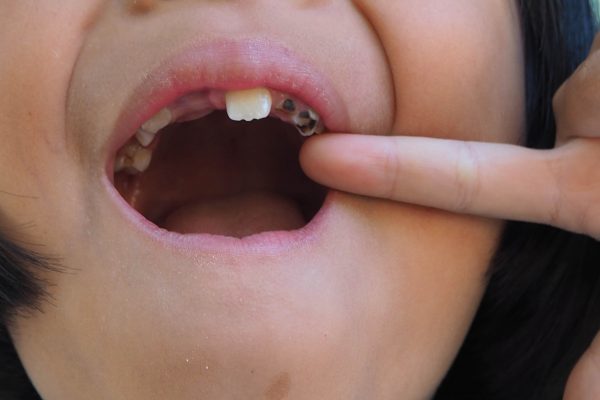 child oral health