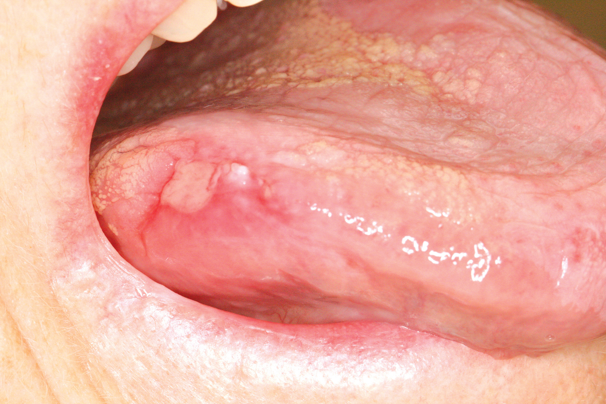 PDF) Laser Treatment of Oral Mucosa Tattoo