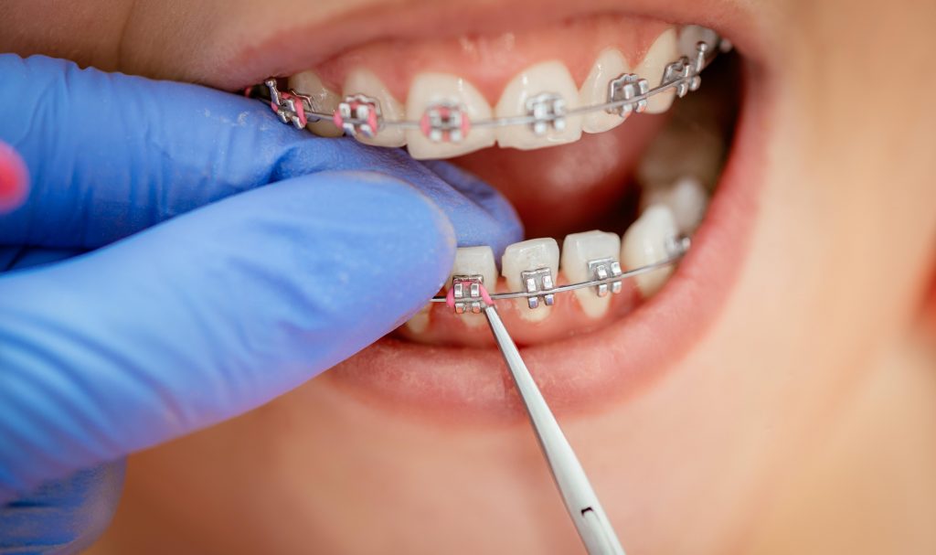 Growing number of UK adults seeking orthodontic treatment Dentistry.co.uk
