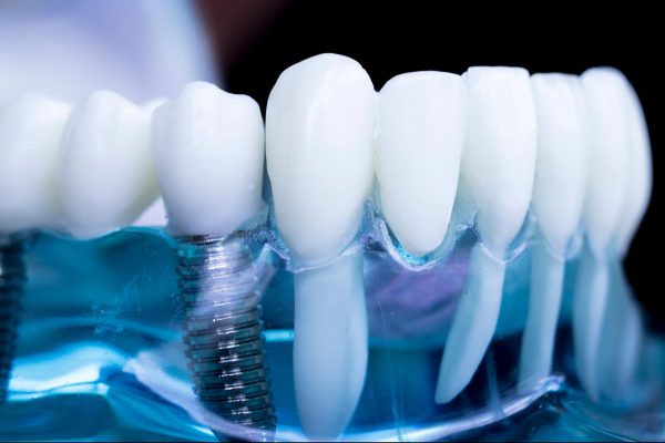 Dental implant showing dental implant training is coming to Portsmouth