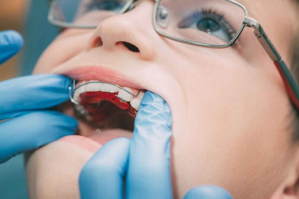 Tendering process for NHS orthodontics is creating a 'race to the bottom', BDA claims