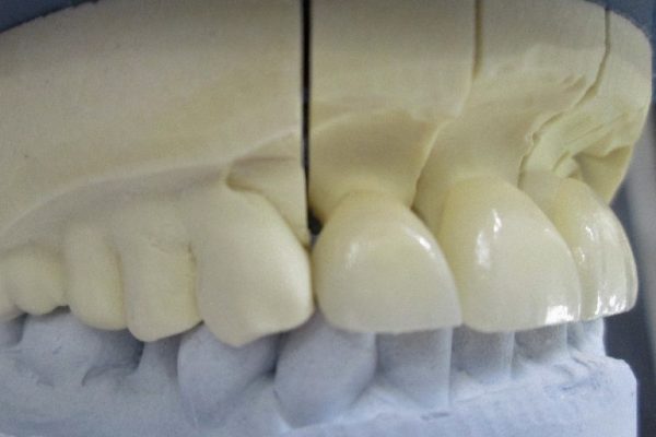 ultra-translucent zirconia