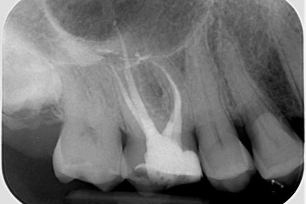 Root canal treatment Figure 5: The post-operative radiograph shows good coronal-apical seal