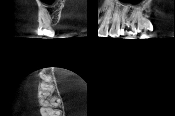 Root canal treatment Figure 3: TheCBCT image shows there was no resorption defect