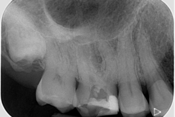 Root canal treatment Figure 2: The pre-operative radiography of the maxillary right first molar (UR6)