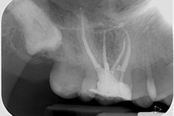 Root canal treatment Figure 6: A distal-angled view shows confluence between the MB1 and MB2