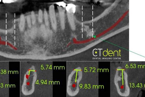 CT Dent scan showing cross-sections through selected areas of the mandible