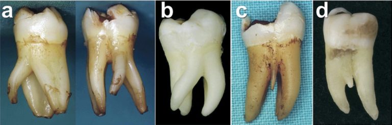 The endo expert – the radix – Dentistry Online