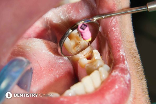 endodontics treatment