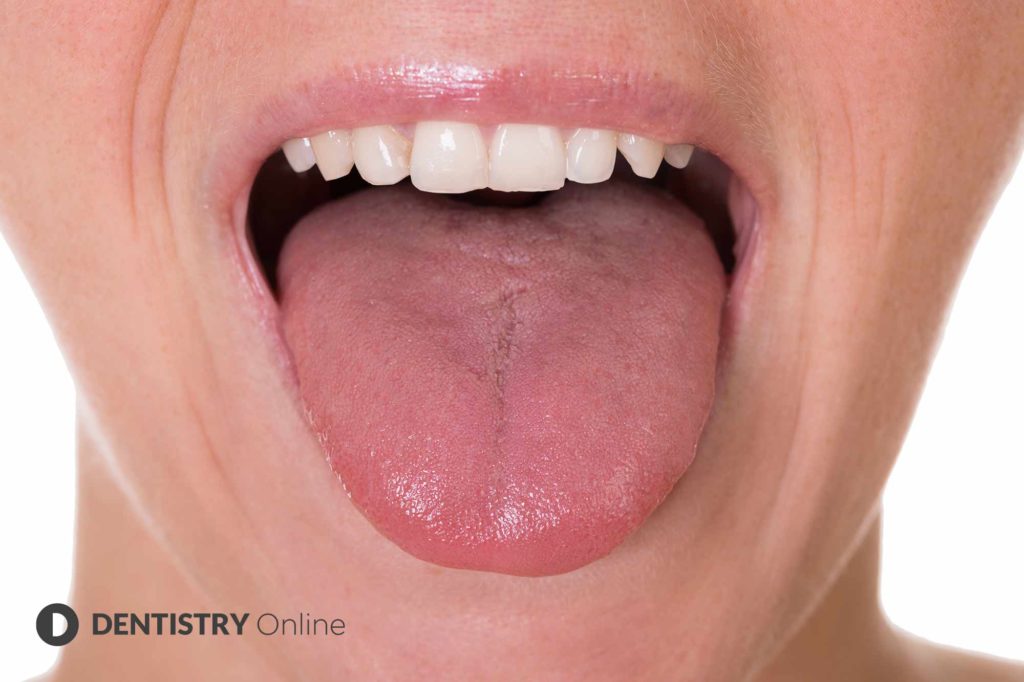 Jump In Cases Of COVID Tongue Health Expert Says Dentistry Online   Covid Tongue Symptom 1024x682 