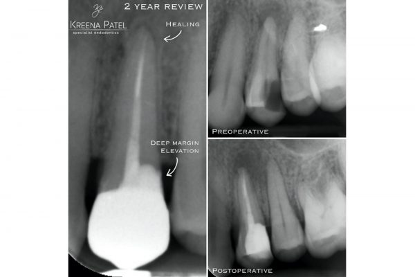 Figure 5: Root canal treatment, fibre post, and composite core UL4. A zirconia crown was placed by the patient general dentist (Dr Davesh Patel) using DME. At the 1 year review the patient was asymptomatic, the PA radiolucency was resolving and the crown & DME margin was sound. **Crown by Dr Davesh Patel @davesh_dentistry**