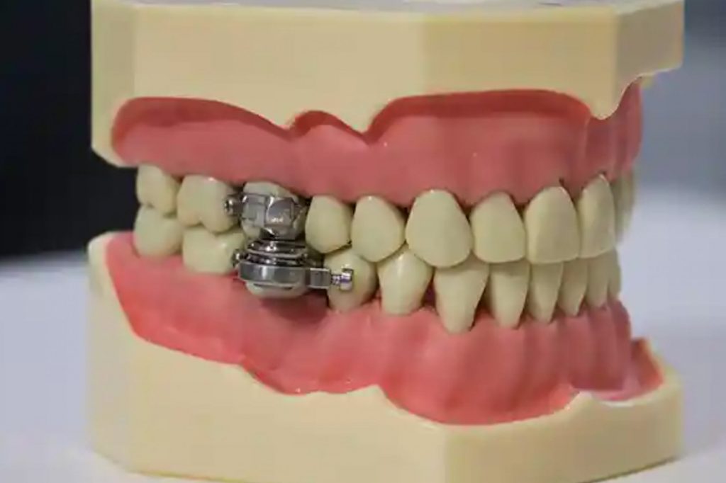 Weight loss dental device designed that stops mouth opening Dentistry