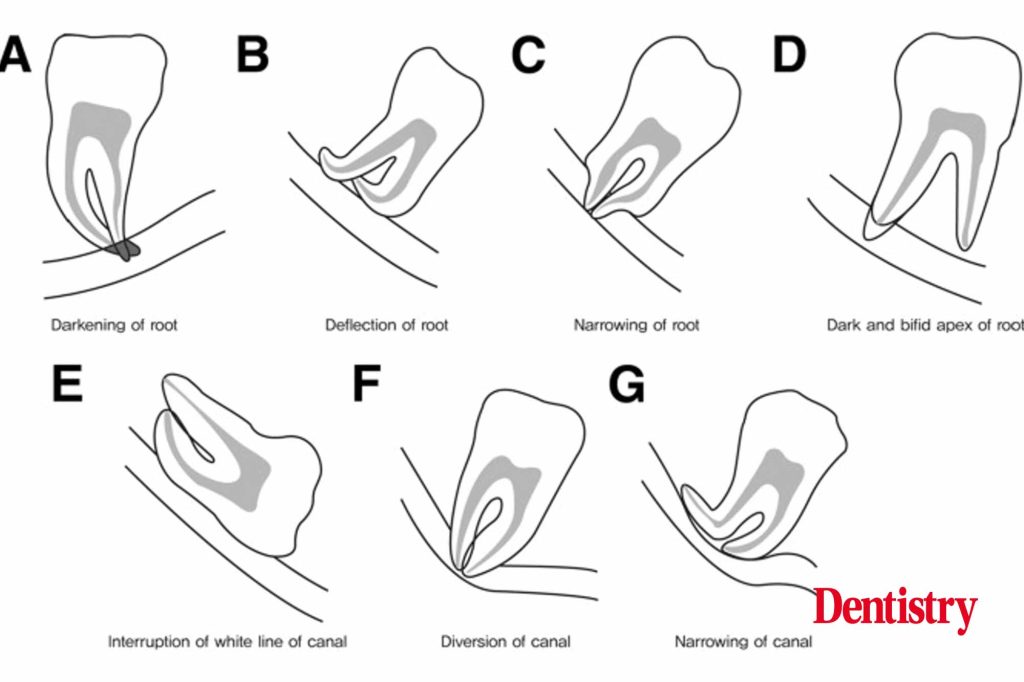 A dental student’s guide to…mandibular third molars - Dentistry