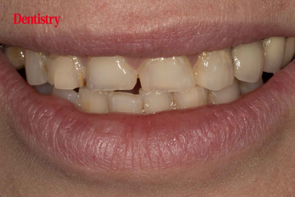 Prosthodontips – Smile Design - Dentistry