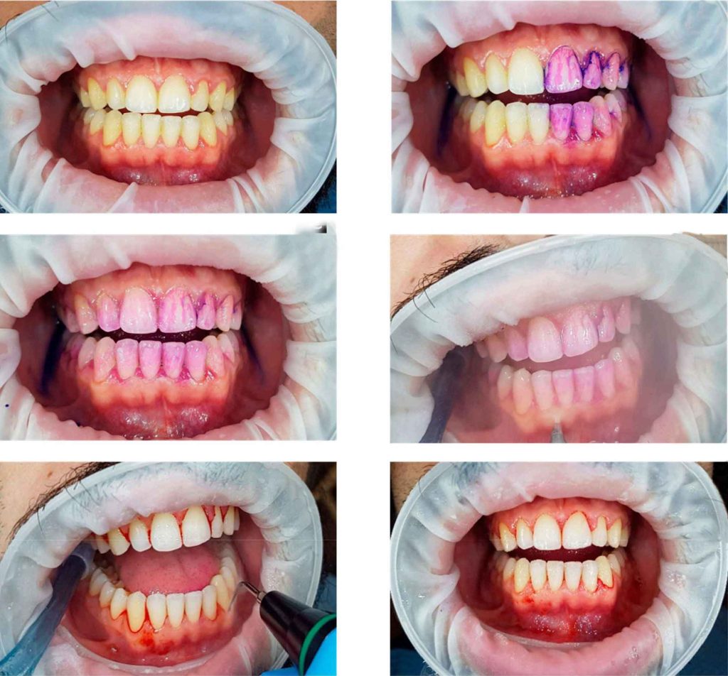 Modern dental biofilm management - Dentistry