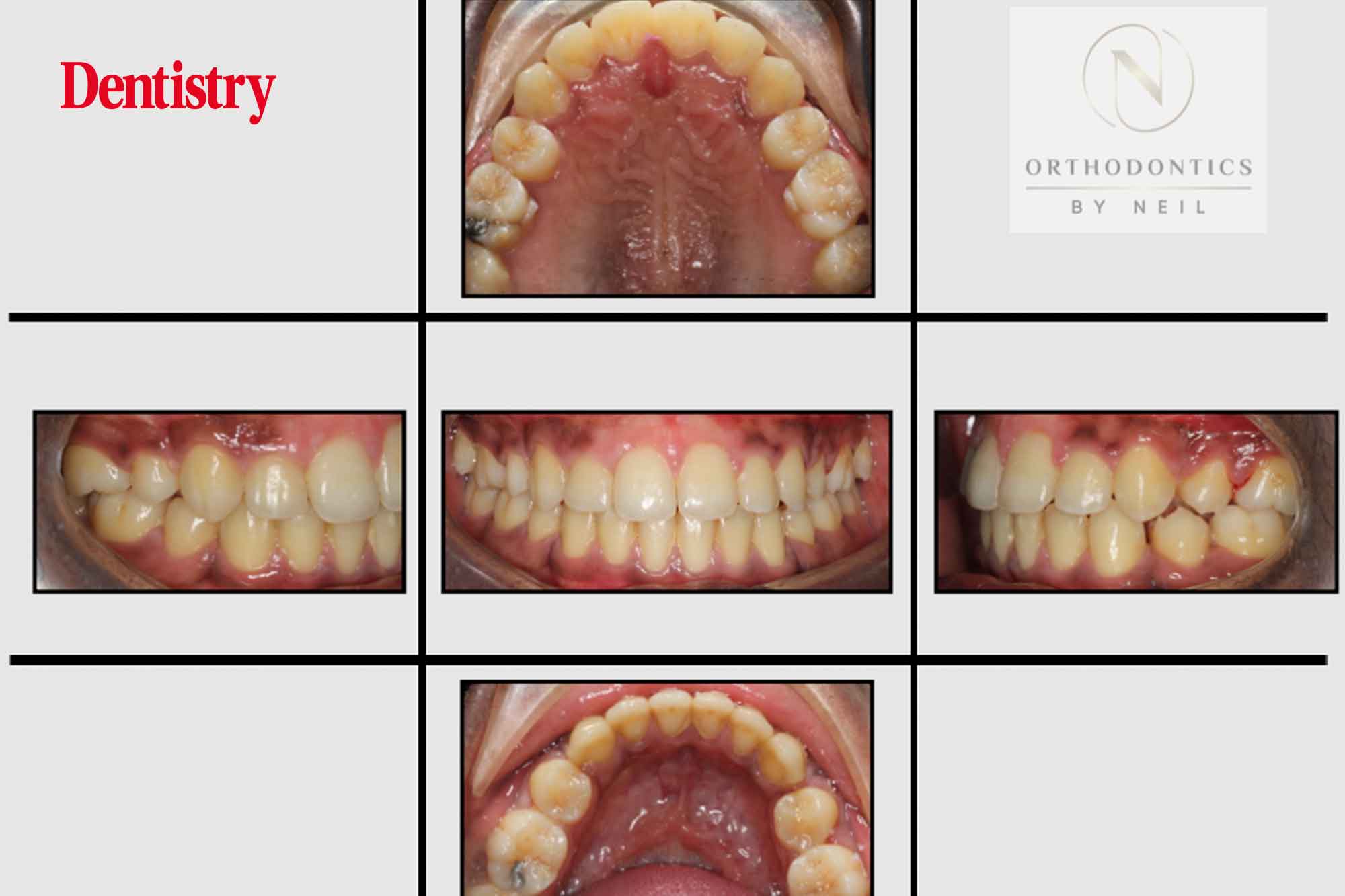 anterioropenbite2 Dentistry.co.uk