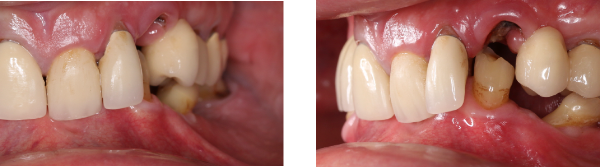 Occlusion