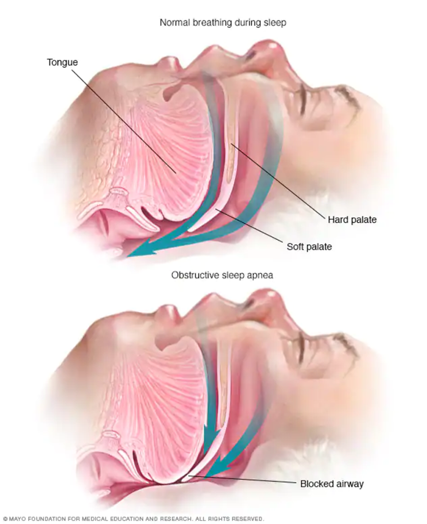 Snoring, facial growth and nutrition What are the links? - Dentistry