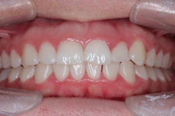 Post-treatment; following aligners and tooth whitening treatment