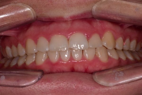 Mid-treatment; following orthodontic aligner and prior to tooth whitening