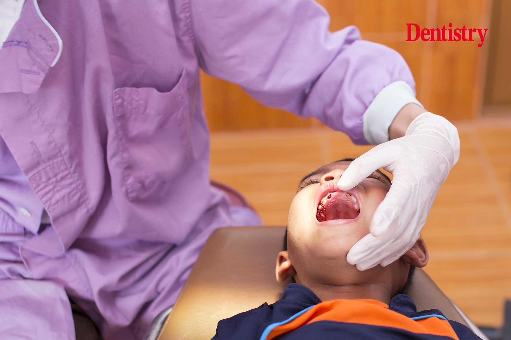 Number of child tooth extractions halved during pandemic Dentistry