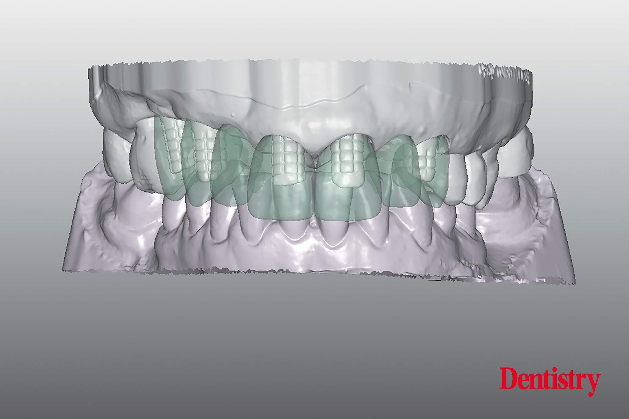 Digital workflow: a game changer for implant restoration