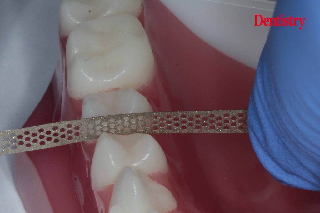 Total Orthodontics – IPR is nothing to fear - Dentistry