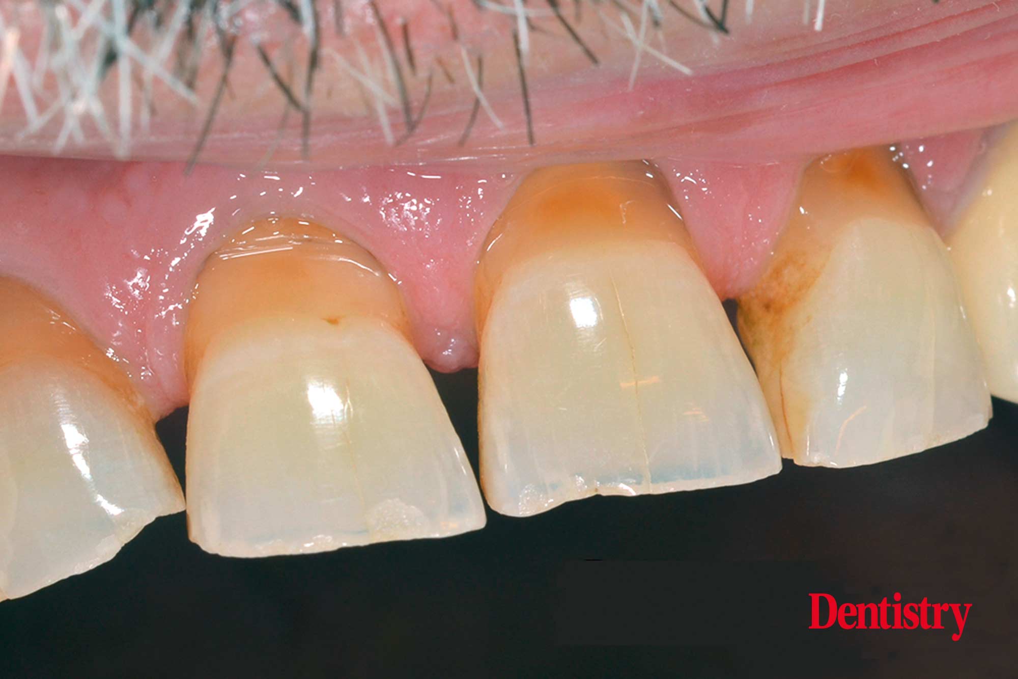 Fabrication and cementation of crowns without chipping