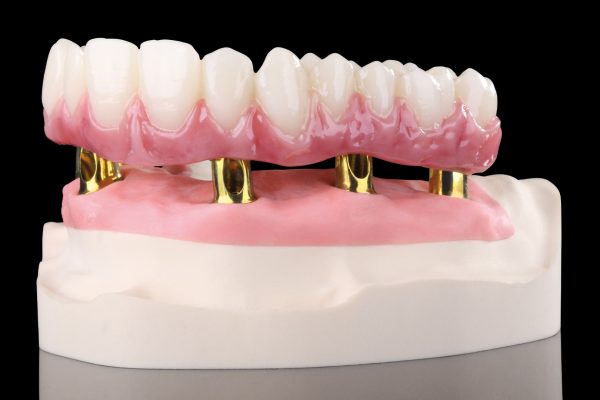 Example of a restoration on individual Raw-Abutments
