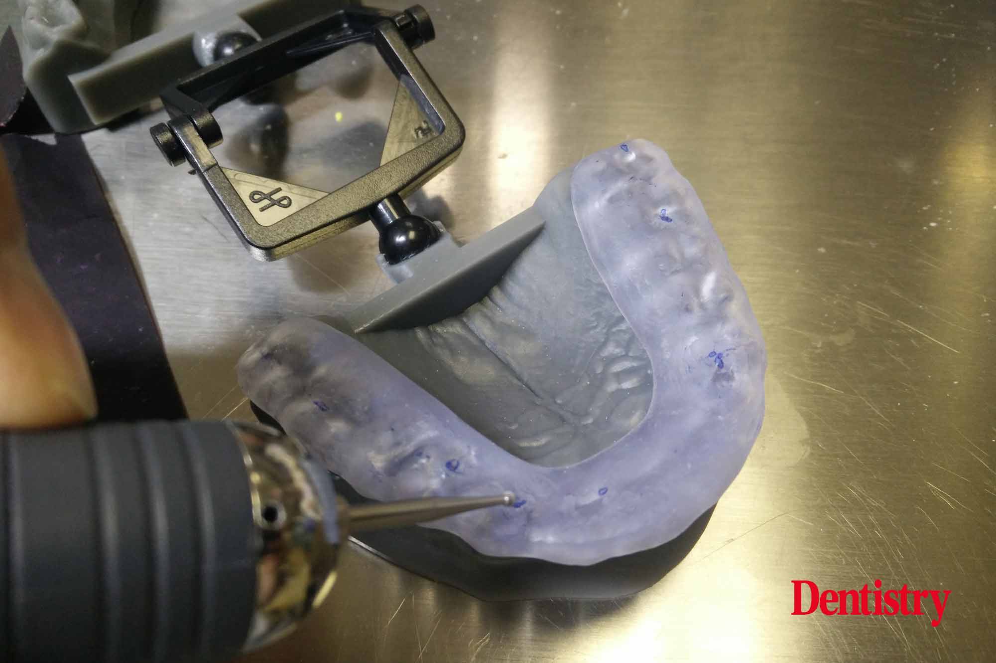 Andre Gaul RDT gives a step-by-step overview of the design and fabrication process of printed occlusal splints.