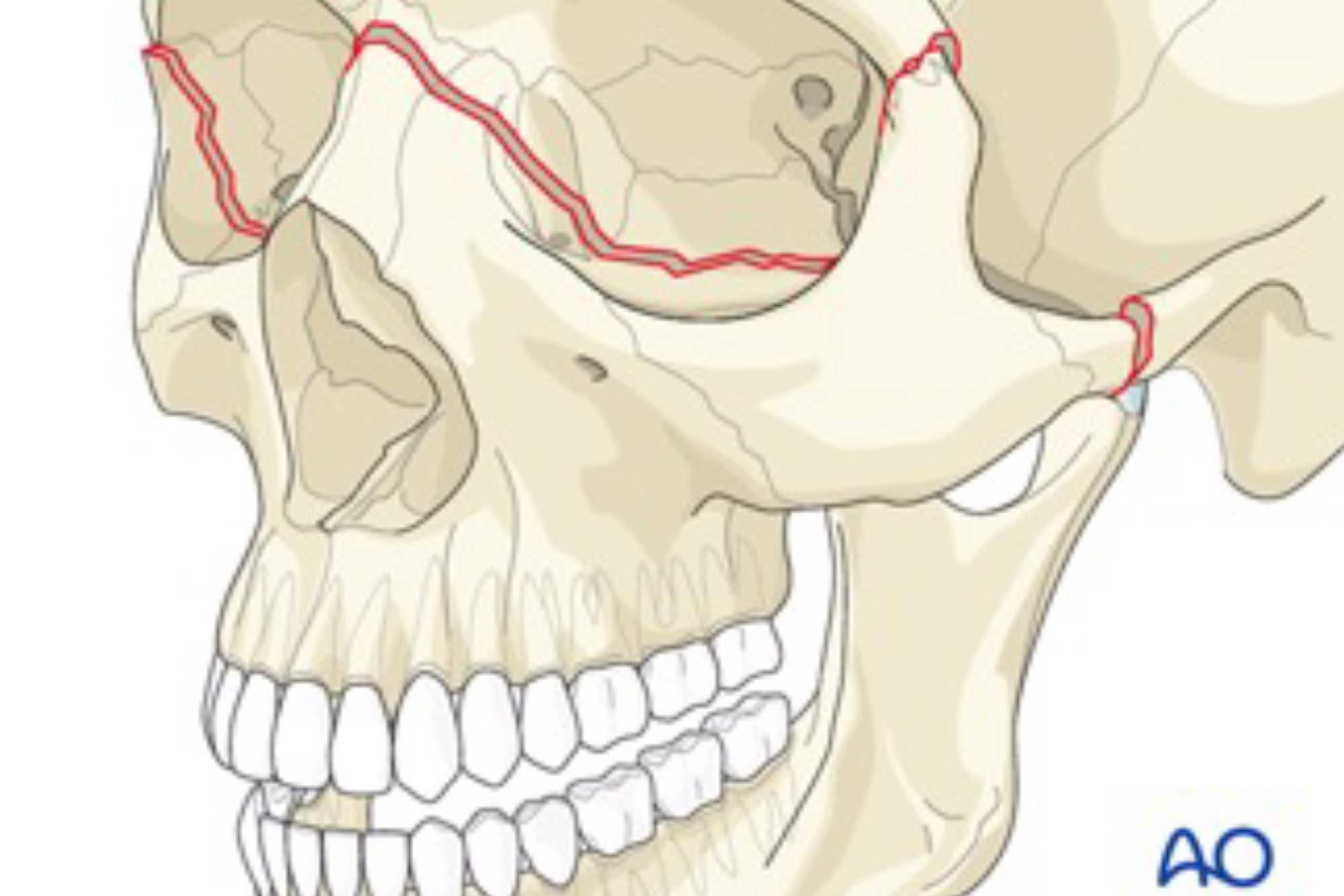 Переломы костей верхней челюсти. Перелом верхней челюсти Лефор 2. Переломы верхней челюсти по Лефор.