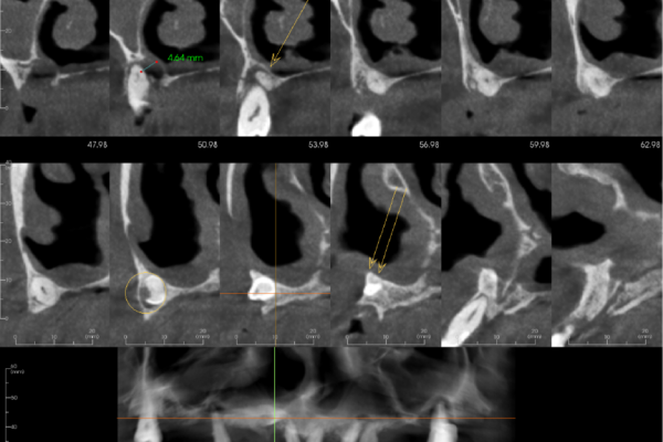Cropped panoramic and 12 cross sections with 3 mm spacing between slices of alveolar ridge showing the unerupted UR3 and its relationship with the UR5 and UR1