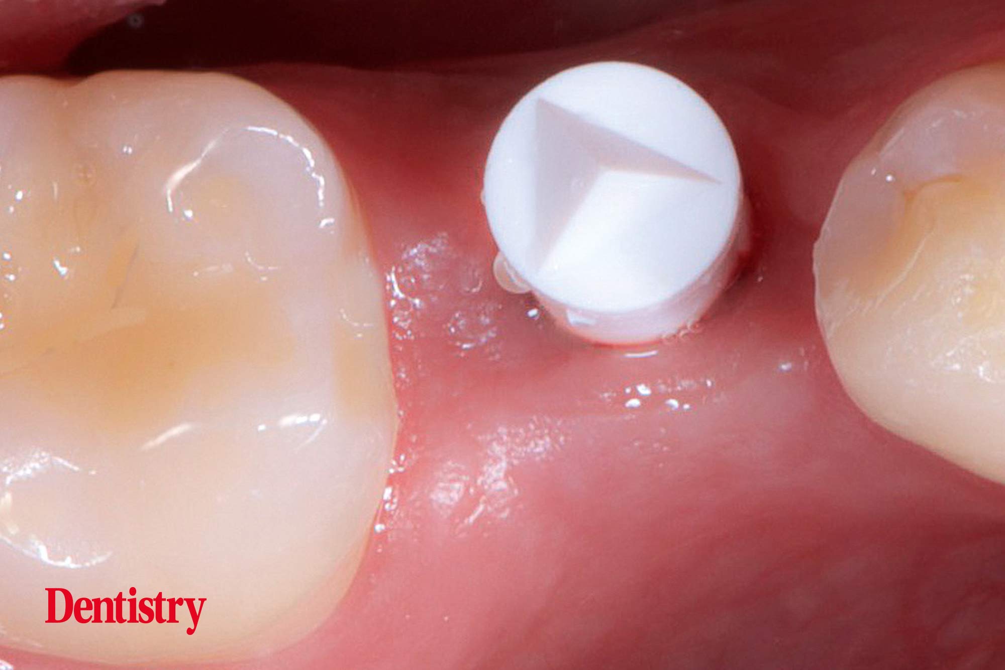 Mauro Fazioni and Andrea Lombardo discuss the importance of making implants with toothlike restoration materials and how you can do this.