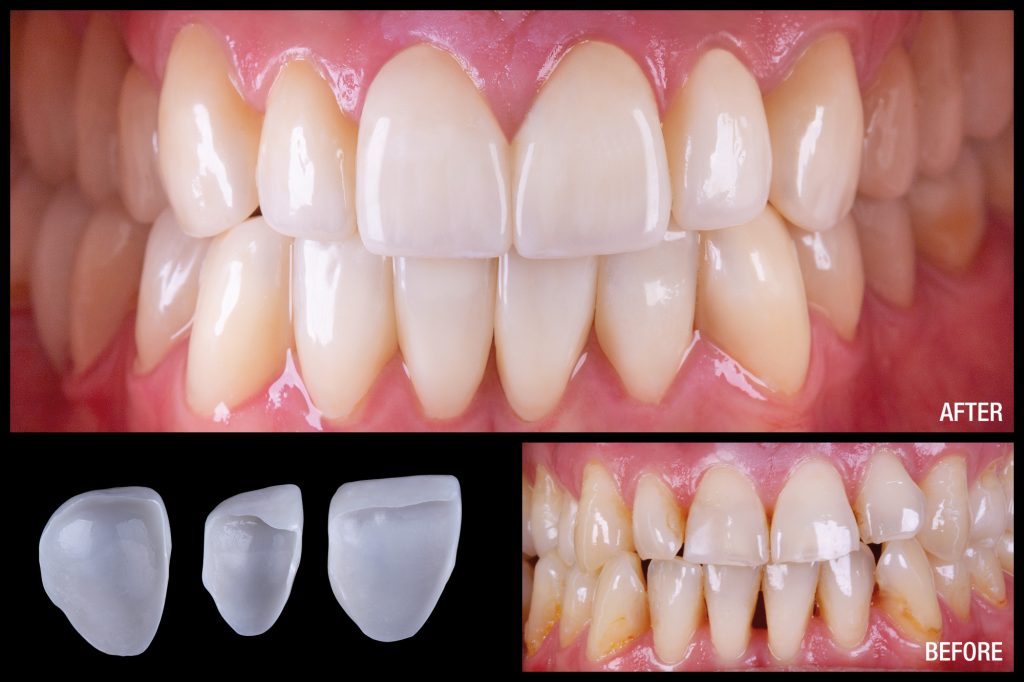 Prettau Skin ultrathin veneers made of Prettau zirconiaDentistry