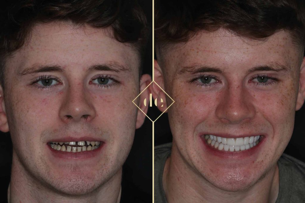 The injectionmould technique for composite veneers Dentistry