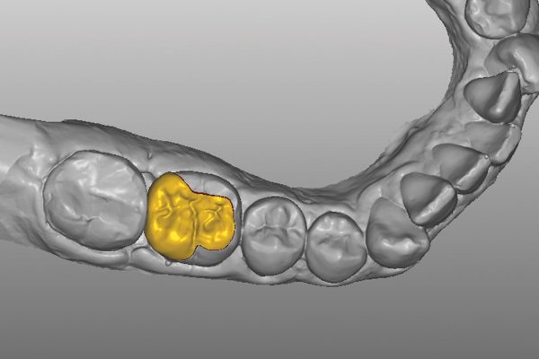 Alan Cantagalli presents an onlay restoration case using natural-looking onlays, digital scanning and CAD design.
