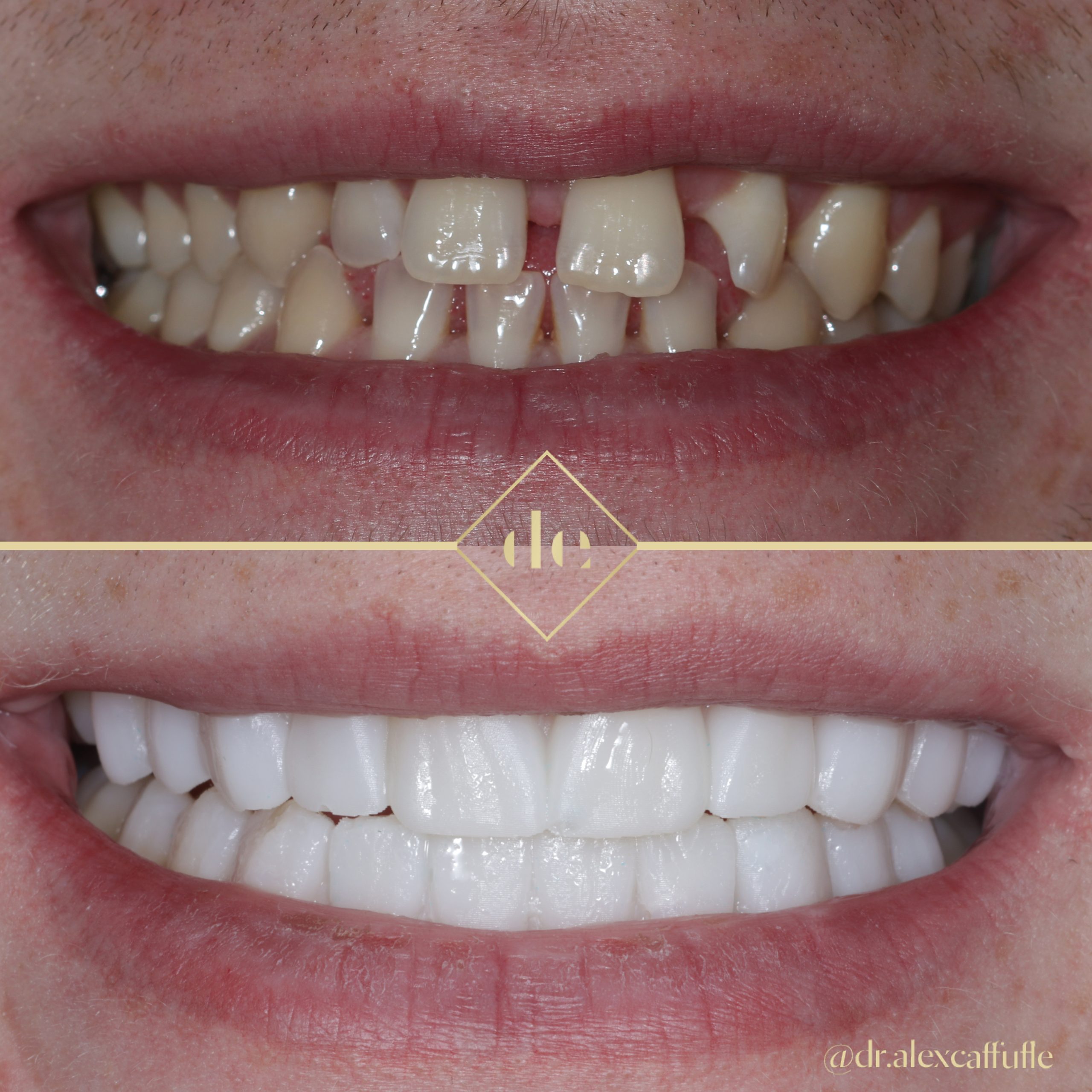 The Injection Mould Technique For Composite Veneers Dentistry