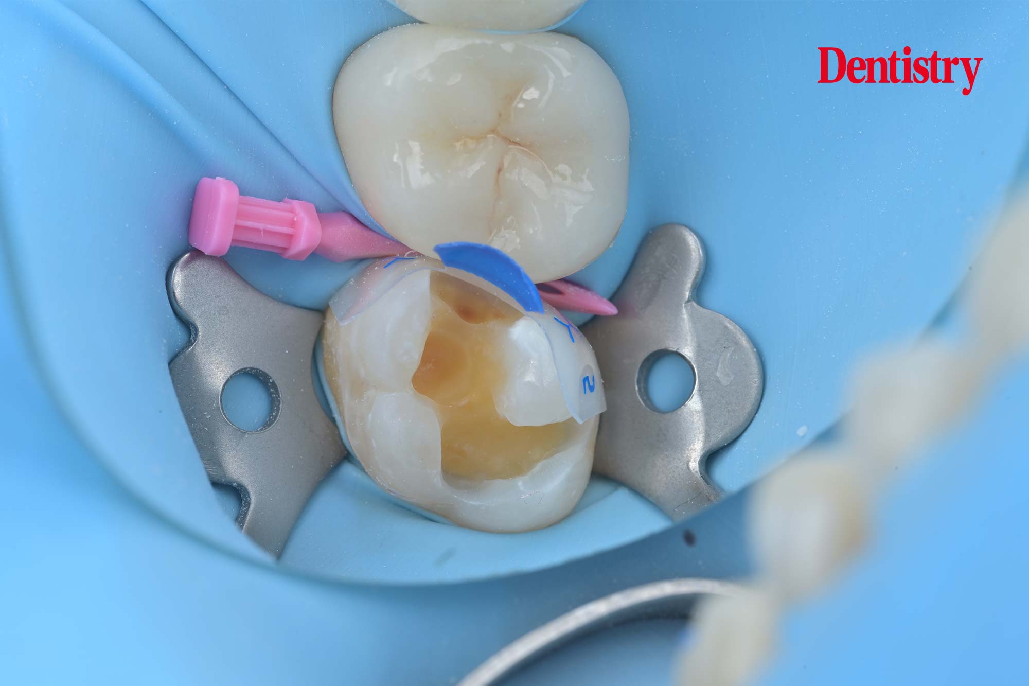 A cuspby-cusp additive technique with composite - Dentistry
