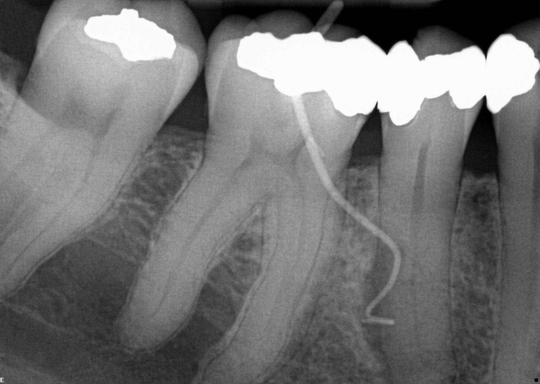 Endodontics 101 understanding the basic principles Dentistry