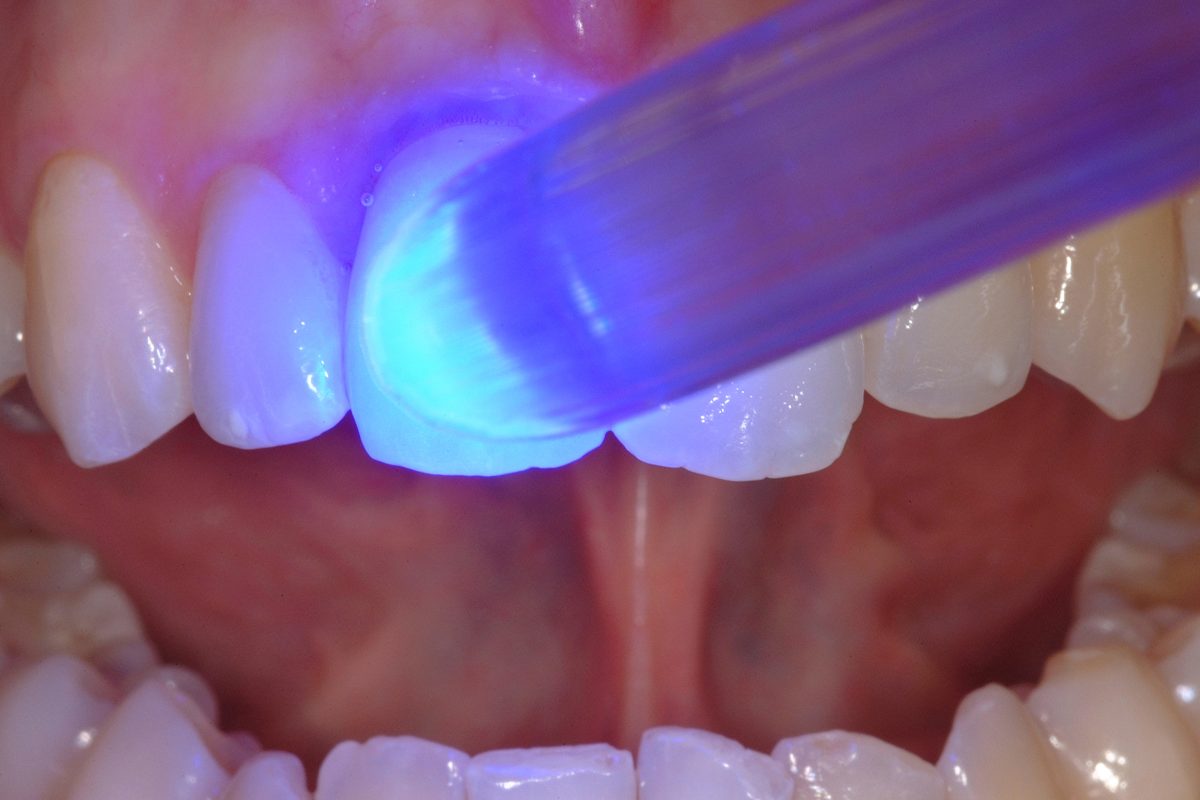 Ceramic Crown_020d Dentistry.co.uk