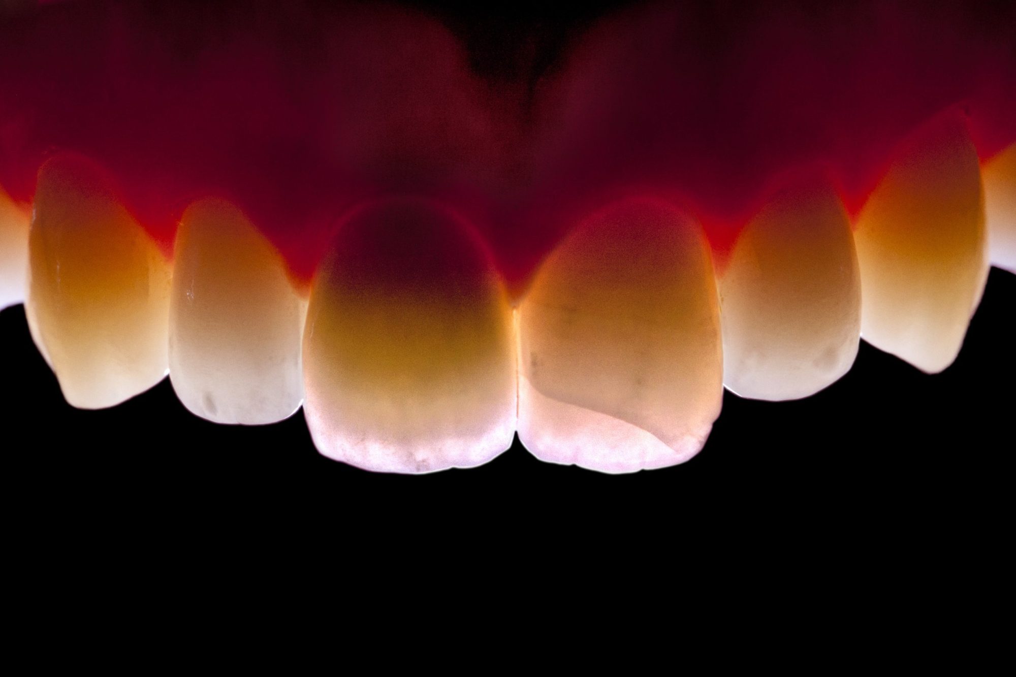 Figure 22: Excellent light transmittance capacity of the ceramic crown, indistinguishable from the neighbouring dentition
