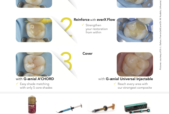 GC's direct posterior restoration workflow