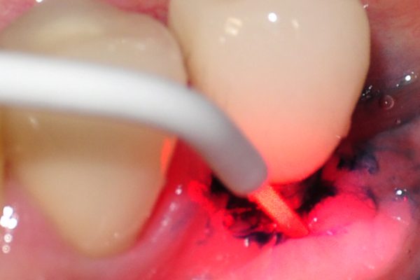 use of photodynamic therapy