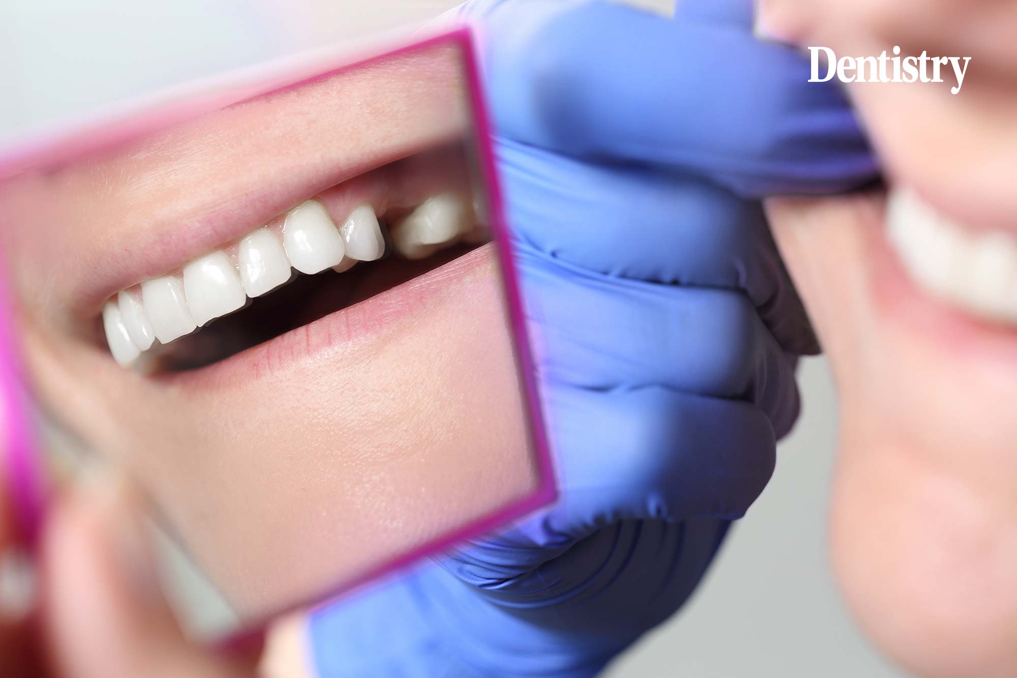 Dry Sockets Demystified: Understanding the Connection to Tooth