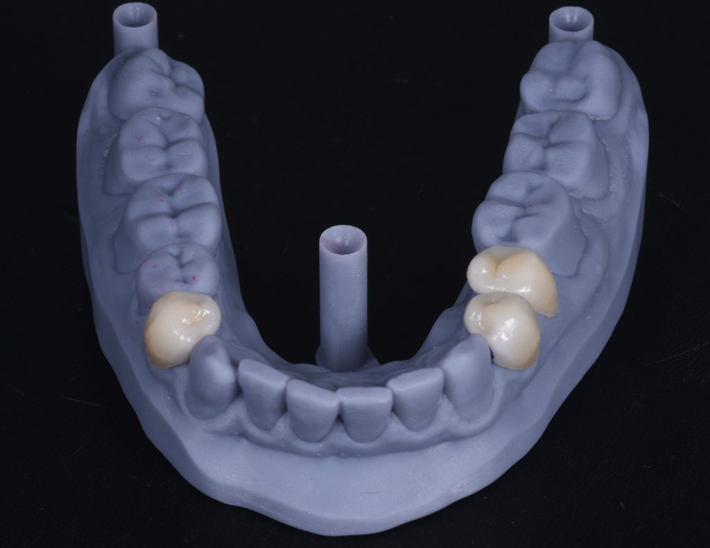Minimally invasive rehabilitation with a digital workflow Dentistry