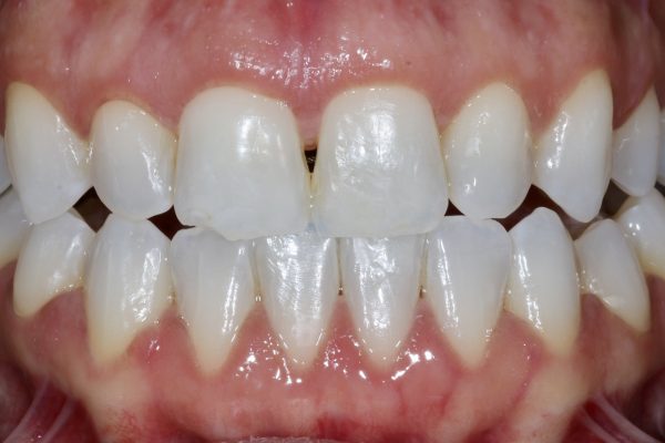 Nishan Dixit describes a minimally invasive alignment, bleaching and edge-bonding case in which the patient was ‘elated and confident’ after their smile transformation.