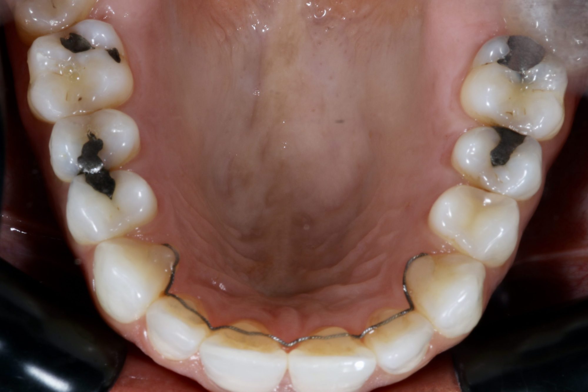 Nishan Dixit describes a minimally invasive alignment, bleaching and edge-bonding case in which the patient was ‘elated and confident’ after their smile transformation.