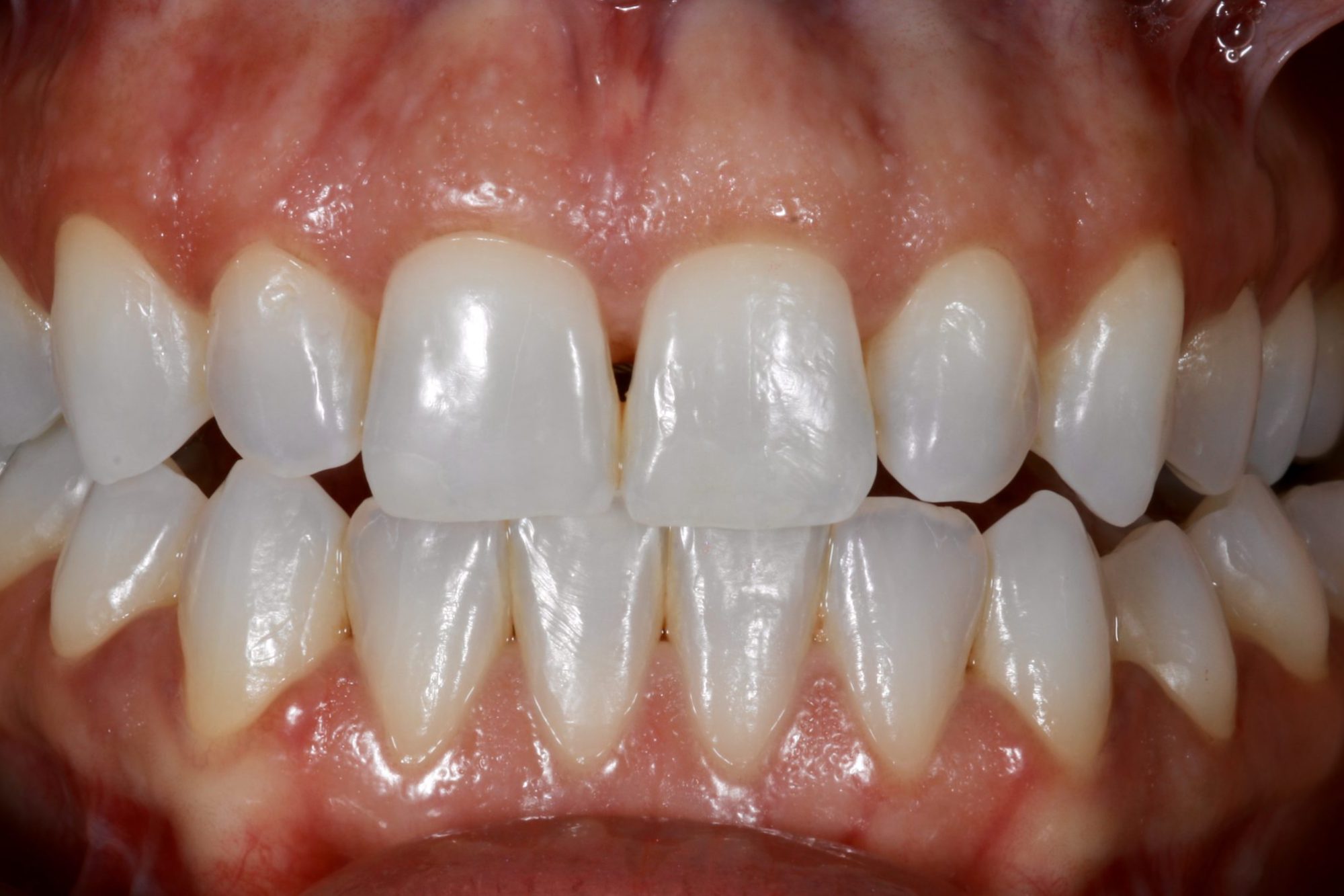 Nishan Dixit describes a minimally invasive alignment, bleaching and edge-bonding case in which the patient was ‘elated and confident’ after their smile transformation.