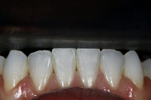 Nishan Dixit describes a minimally invasive alignment, bleaching and edge-bonding case in which the patient was ‘elated and confident’ after their smile transformation.