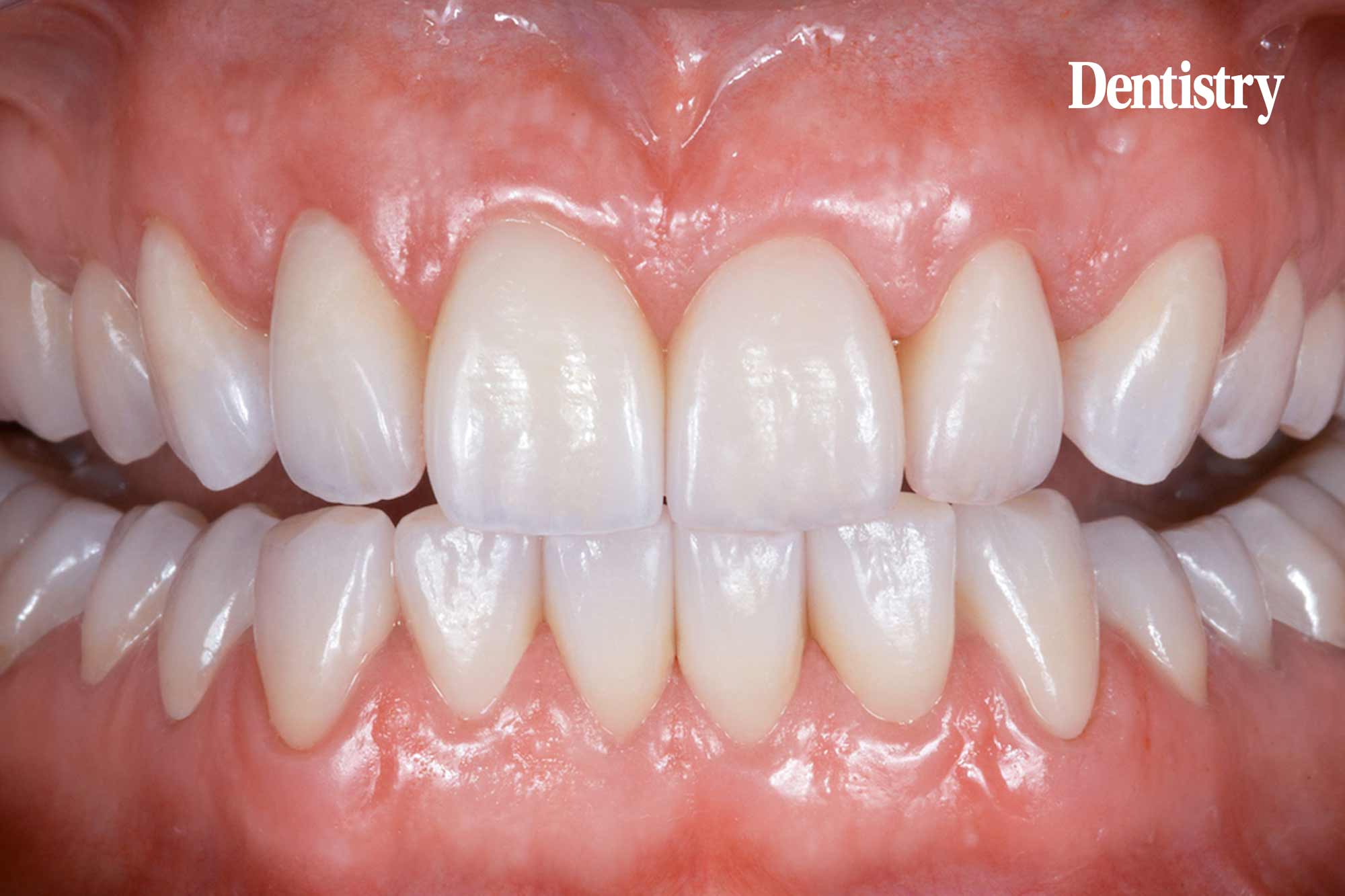 Treatment of tooth wear with zirconia crowns
